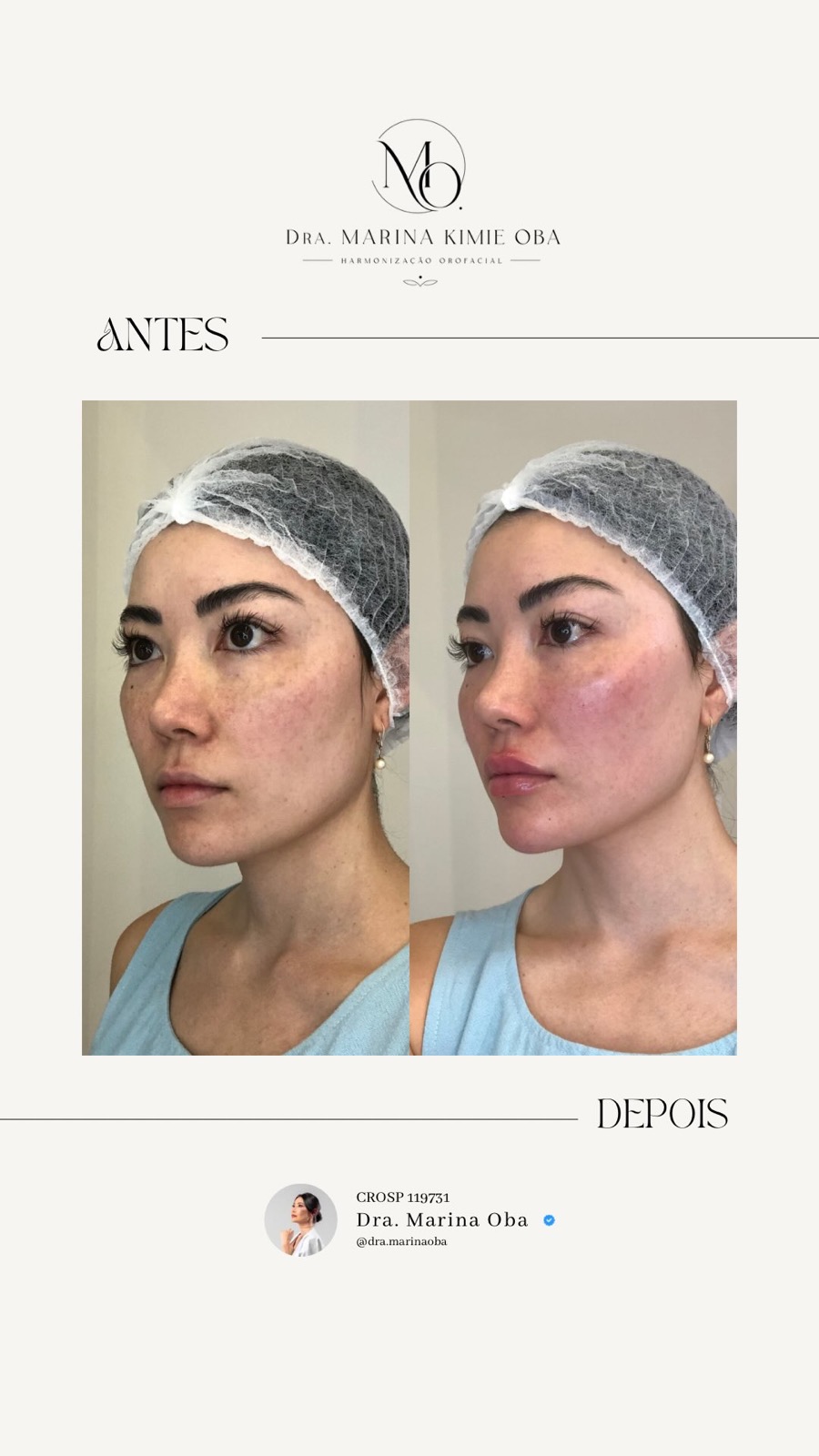 Antes e depois da própria Dra. Marina Oba, resultado de harmonização orofacial
