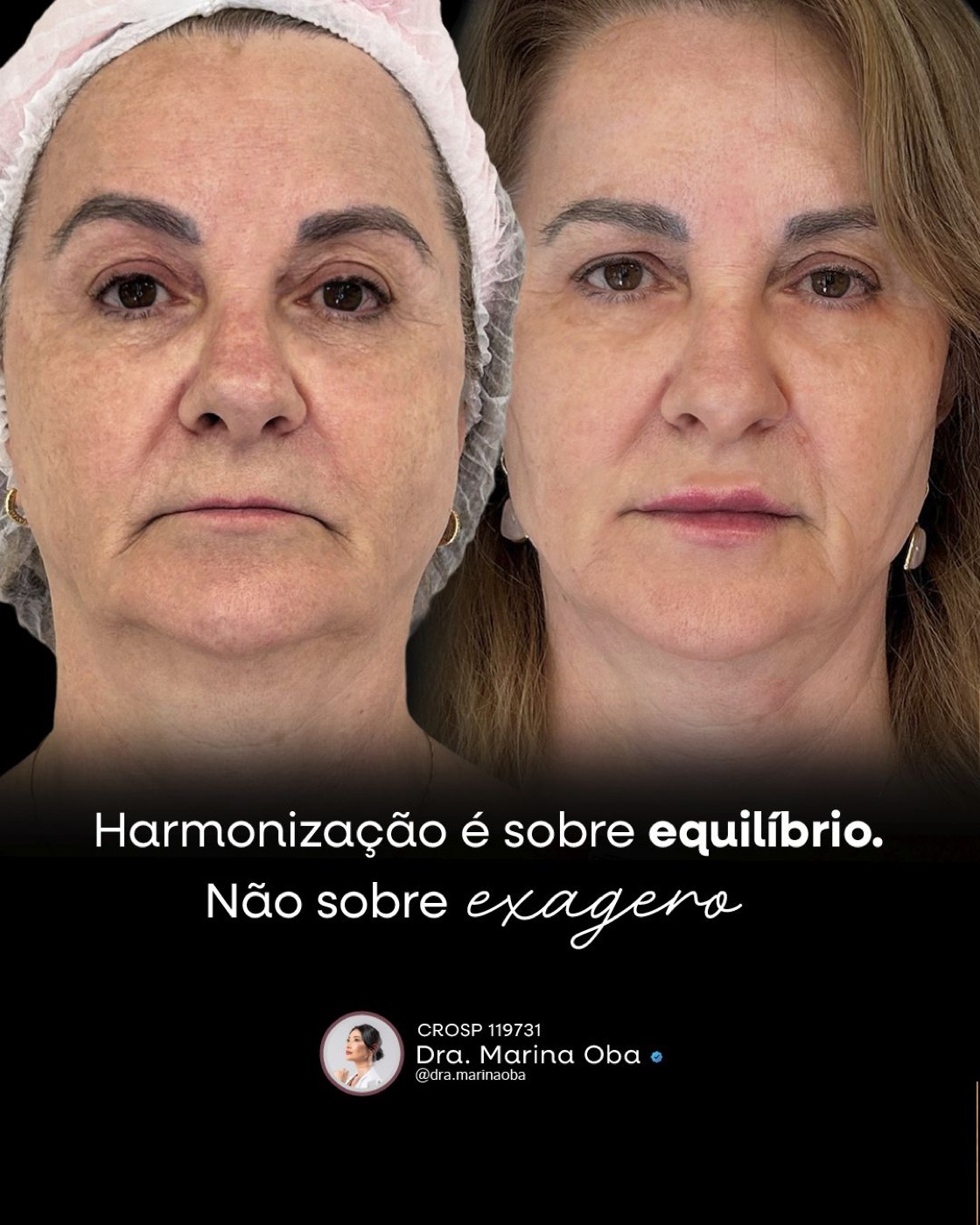 Antes e depois de harmonização orofacial pela Dra. Marina Oba: harmonização é sobre equilíbrio, não sobre exagero